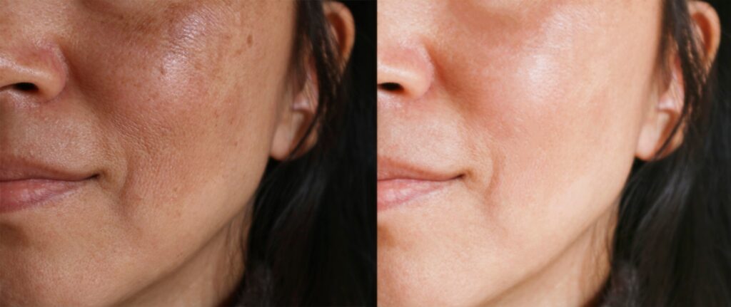 The Revitapen Treatments Can Make A Remarkable Difference For Lines, Wrinkles, And Hyperpigmentation.