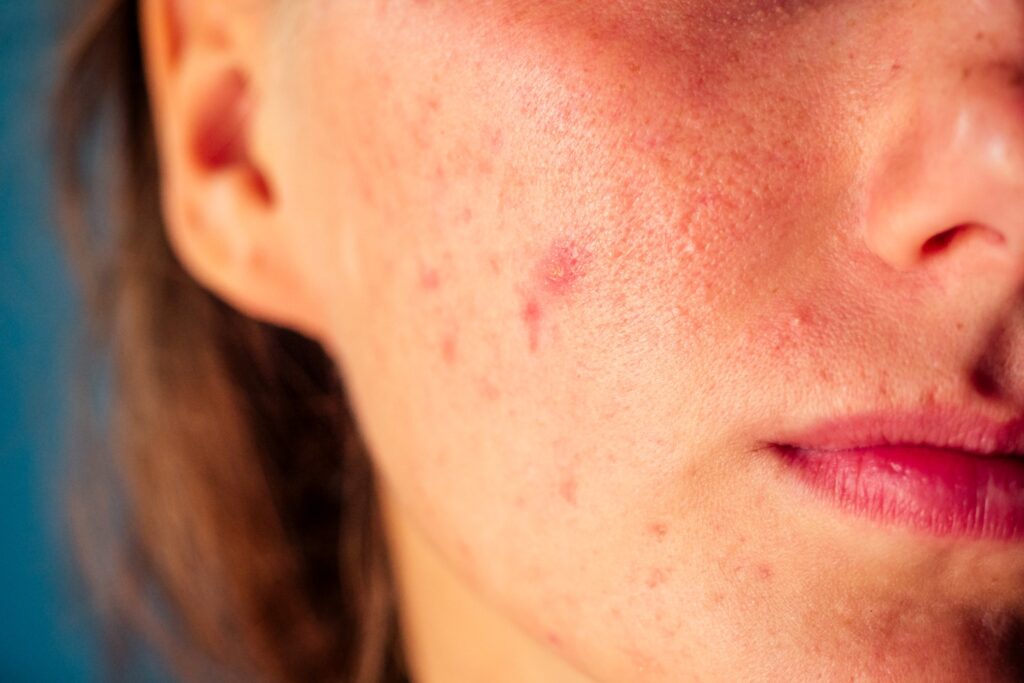 Closeup Of Woman'S Face With Acne.