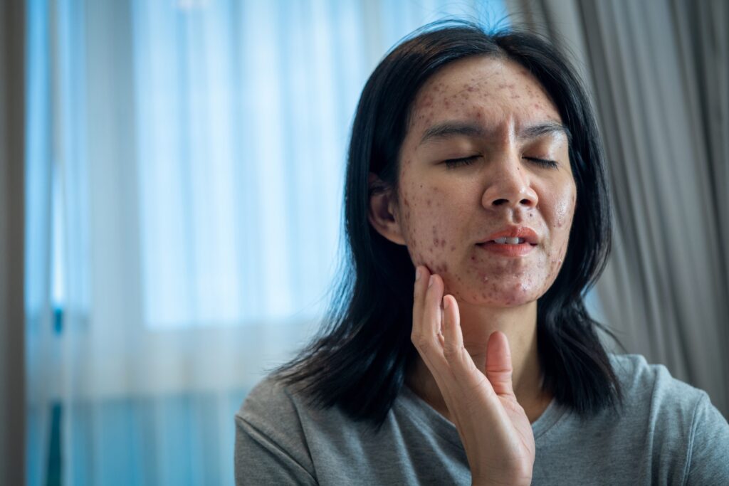 Image Of A Woman With Painful Acne On Her Face.