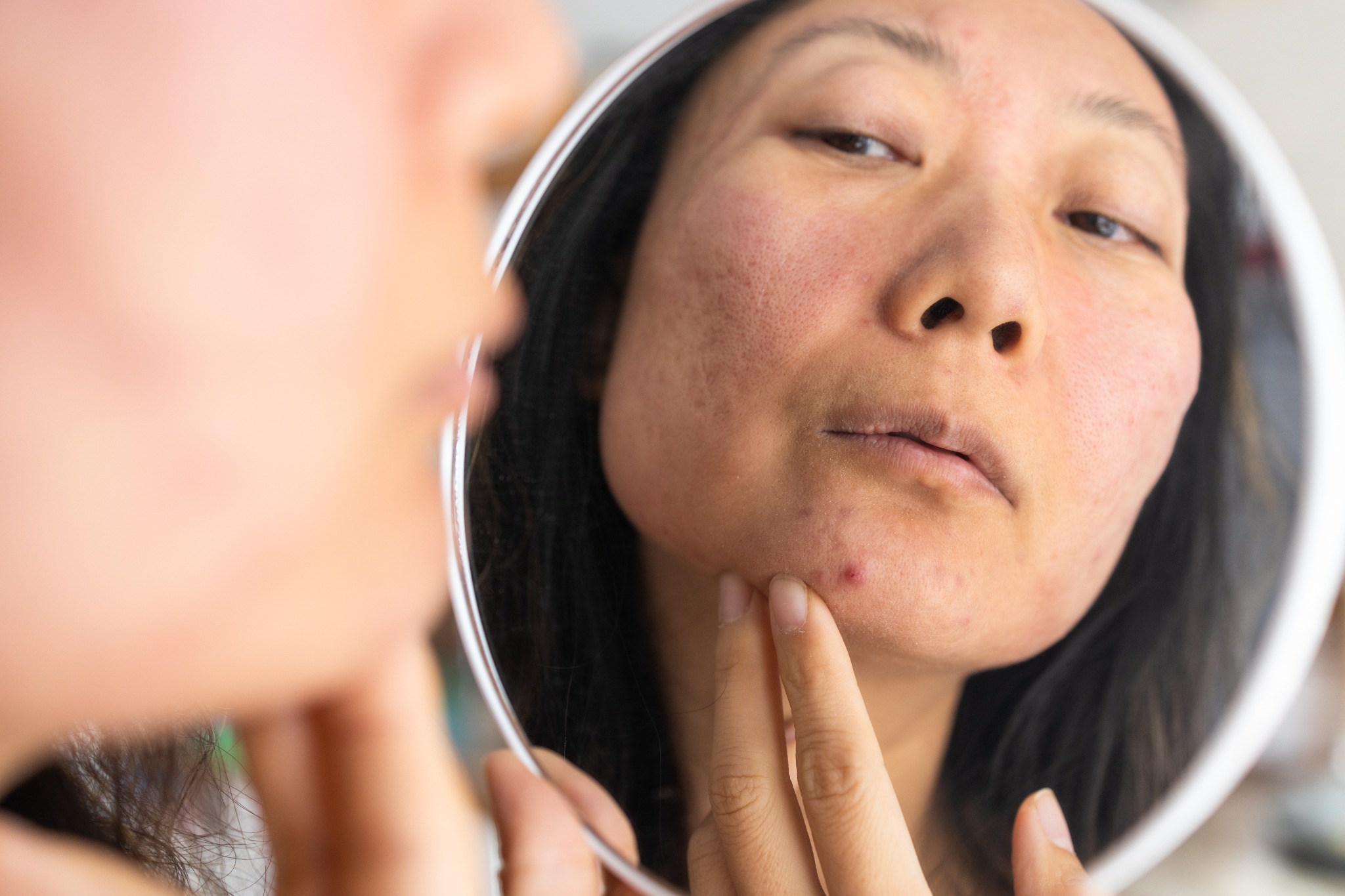 Image of Asian woman looking at acne in mirror