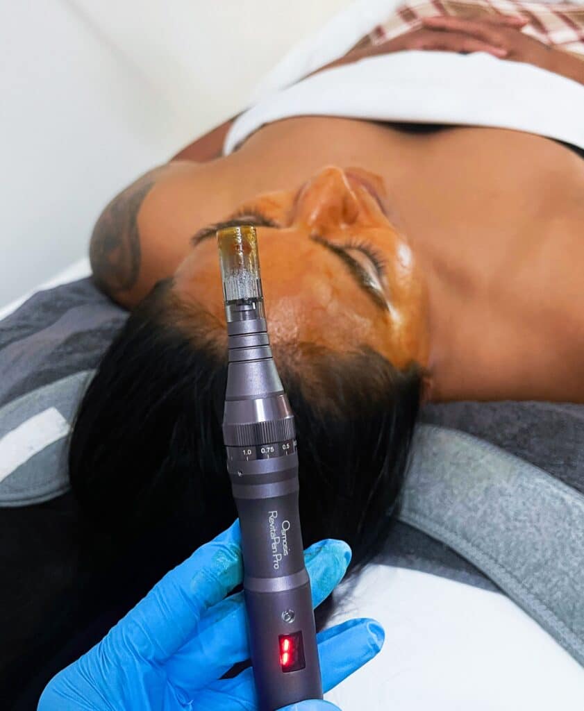 4 Benefits Of Getting An Infusion Facial | Xenana Spa | Portland Oregon Image Of Woman Receiving Microchanneling Treatment During An Infusion Facial, Available In Portland, Oregon At Xenana Spa